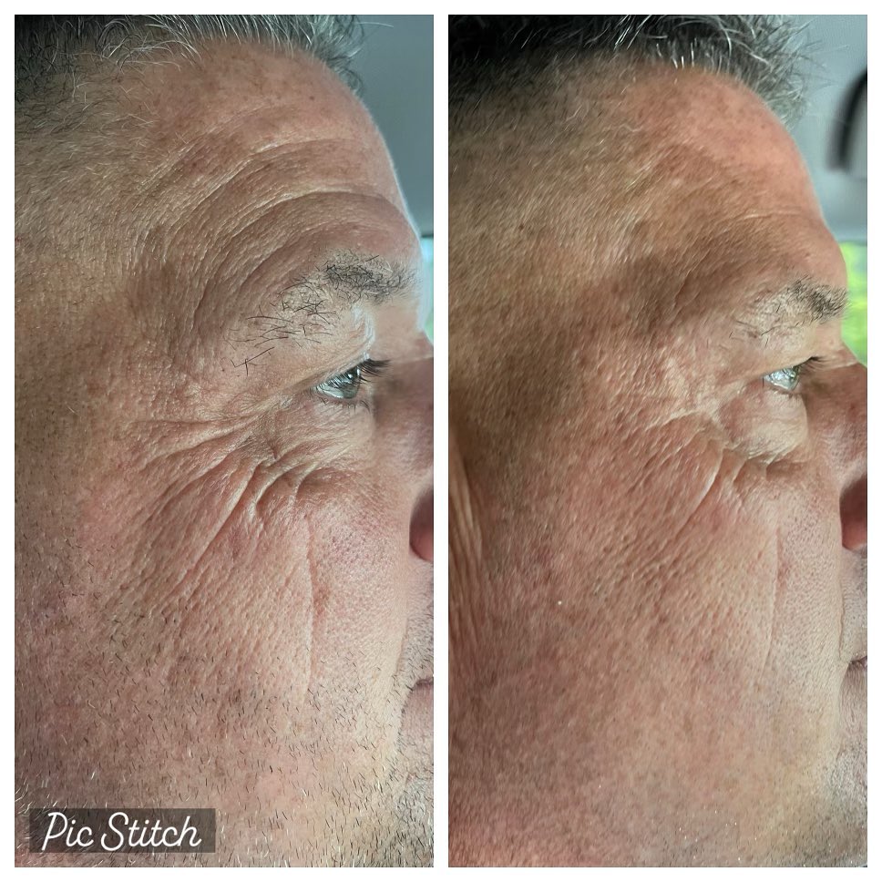 Male client before and after Dysport and Restylane Defyne filler
