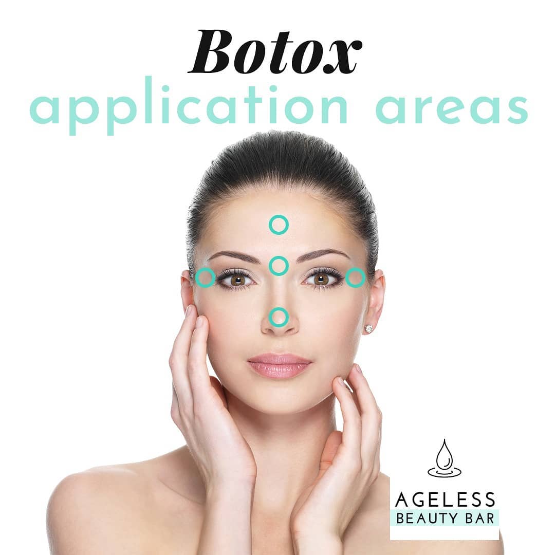 Diagram of Botox treatment areas on the face